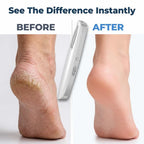 Arenzza electric callus remover showing before and after images of smooth, exfoliated feet with professional pedicure results at home.