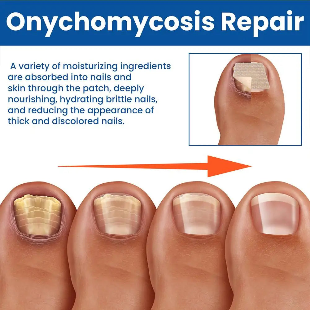 HealthyNail™ Fungal Nail Restoration Patches by Arenzza, discreet clear patches for restoring healthy, clear nails.