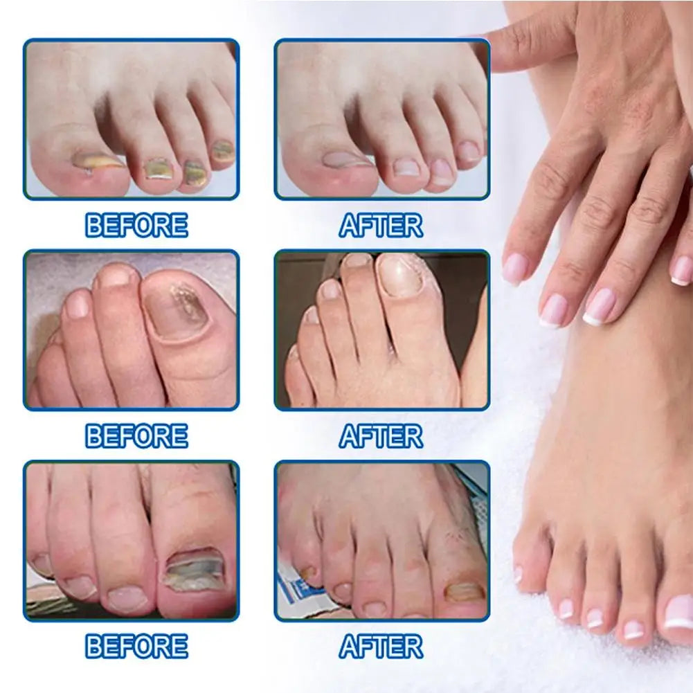 HealthyNail™ fungal nail restoration patches by Arenzza, discreetly restoring clear, healthy nails with natural-looking coverage.