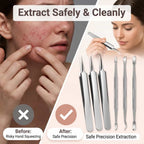 Arenzza stainless blackhead remover kit with hygienic pore care tools shown in a before and after split image.