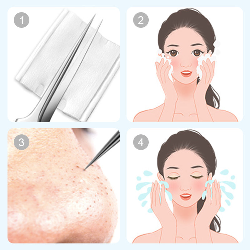Arenzza stainless steel blackhead removal kit with tools and alcohol pads, designed for skincare and pore cleaning.