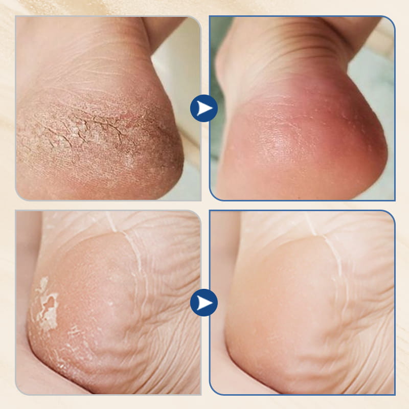 Arenzza hydrating foot cream in a white jar, designed to moisturize and prevent cracking for healthy, soft feet.