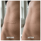 Aurenza DermaShield™ Pro Scar Matrix device with flexible, transparent design for scar treatment and skin healing.