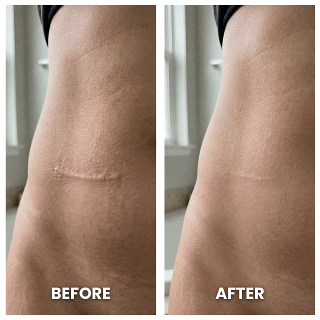 Aurenza DermaShield™ Pro Scar Matrix device with flexible, transparent design for scar treatment and skin healing.