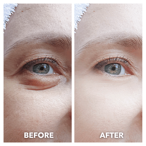 Aurenza LumiLift™ Eye Perfector showing before and after images highlighting skin firming and brightening effects.