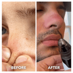 Aurenza Shop blackhead remover pore vacuum cleaner in action, showing the device extracting blackheads from the skin.