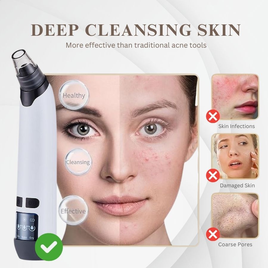 Aurenza Blackhead Remover Pore Vacuum Cleaner with clear suction head and control buttons for facial pore cleansing.