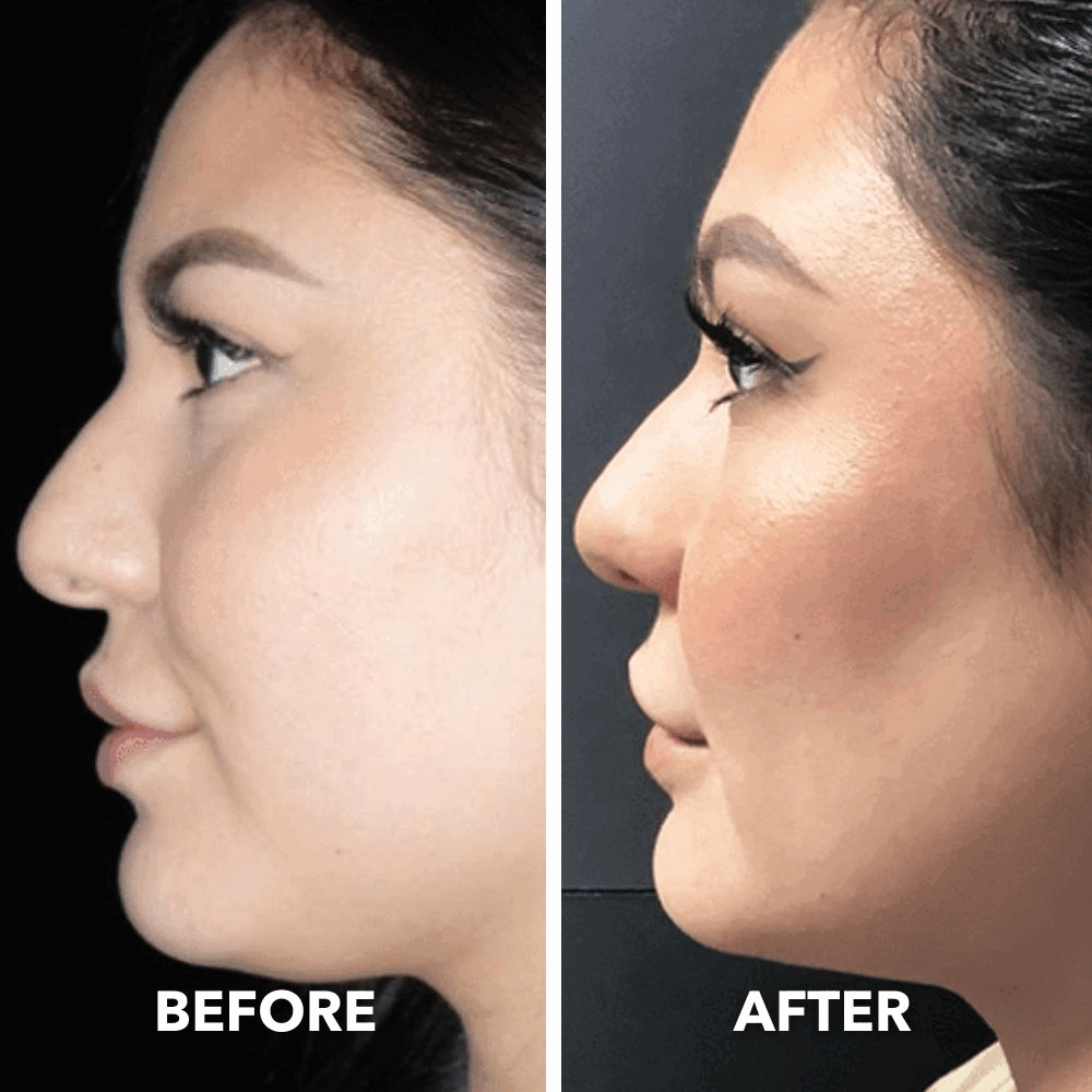 Aurenza Smart Face Sculpting Device showing before and after images of jawline and double chin reduction using 8 modes.