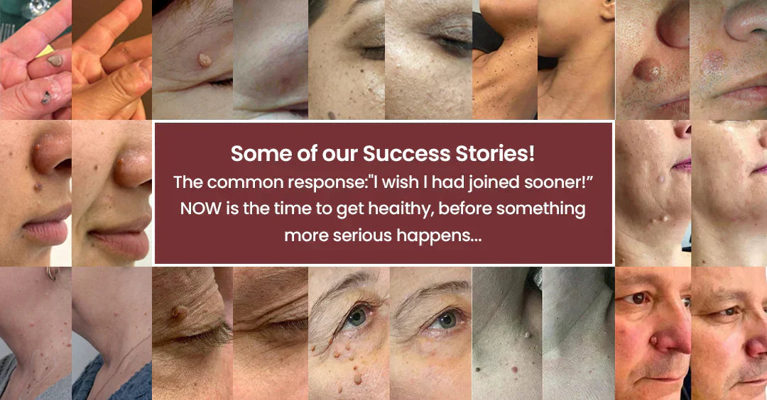 Aurenza 2-in-1 microneedle and hydrocolloid patch for face and body, removing moles, acne, warts, scars, and blemishes.