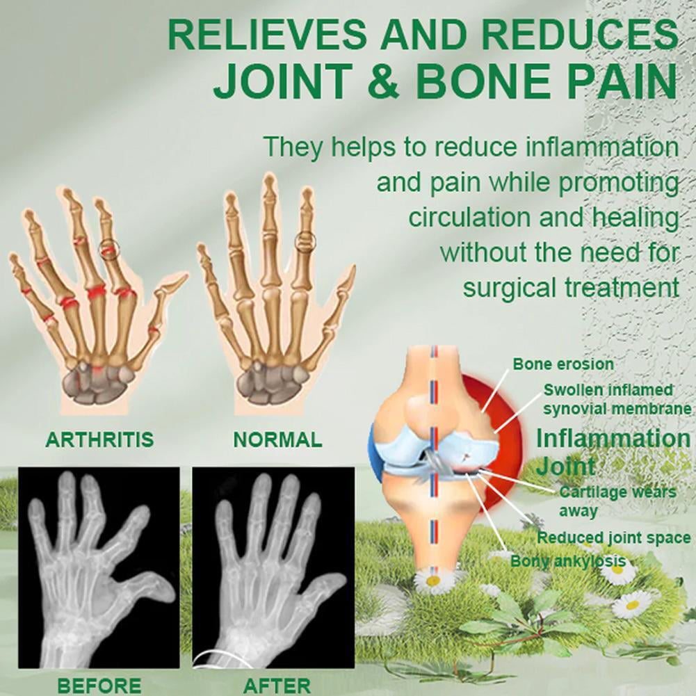 Aurenza Bee Venom Joint and Bone Therapy Advanced Cream jar with label, natural skincare for joint and bone relief.