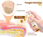 Aurenza Shop Unpree™ Kolirin Bee Venom Nail Fungus Spray bottle with label, designed to treat nail fungus and improve nail health.