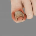 Unpree™ Kolirin Bee Venom Nail Fungus Spray from Aurenza Shop, showing the spray bottle for nail fungus treatment.