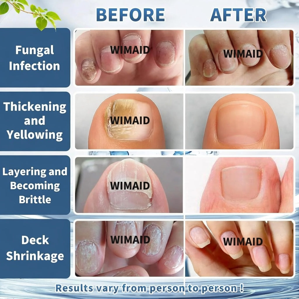 Aurenza Shop extra strength nail fungus treatment bottle with applicator, designed to repair thick, yellow, and damaged nails.