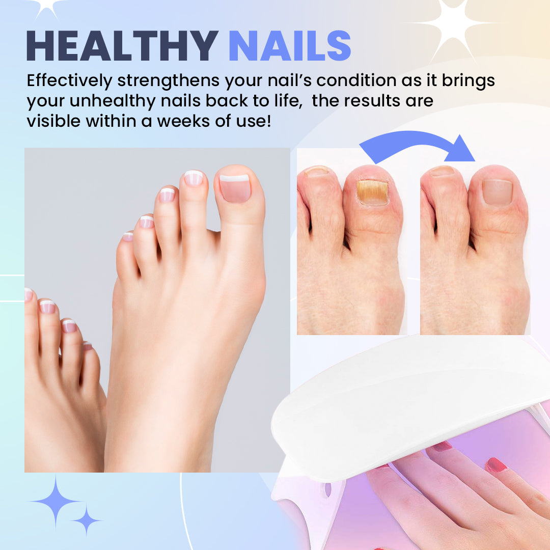 Aurenza Shop SUPTRUCK™ Nail Fungus LED Light Therapy Device for treating nail fungus, shown with its compact design and LED light.