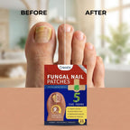 Aurenza Shop Repair Nail Patch for stopping yellow fungus infection on toenails, applied to a toenail in a close-up image.