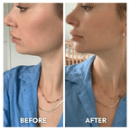Before and after GIF showing Aurenza Shop V-Lift Pro reusable chin strap improving jawline definition and toning.