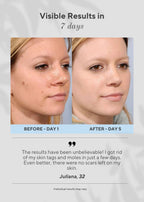 Aurenza Shop 6-in-1 Skin Imperfection Removal Pen showing multiple treatment heads for skincare and blemish removal.