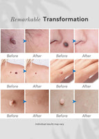 Aurenza Shop 6-in-1 skin imperfection removal pen with multiple attachments for acne, scars, and blemish treatment.