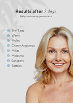 Aurenza Shop 6-in-1 skin imperfection removal pen with various attachments for facial blemish and mole removal on a white background.