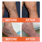 Aurenza Shop VeinEase Microneedle Therapy Patch on skin, showing the small, discreet patch designed for vein treatment.