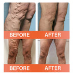 A skin vein treatment patch from Aurenza Shop, featuring small microneedles designed to improve skin appearance and circulation.