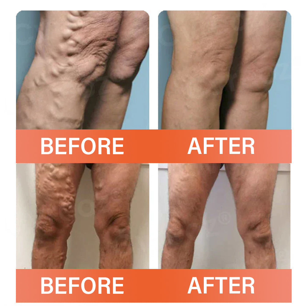 A skin vein treatment patch from Aurenza Shop, featuring small microneedles designed to improve skin appearance and circulation.