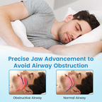 Serenzza anti-snoring and teeth grinding protector for oral health, shown in clear view, ideal for sleep improvement.