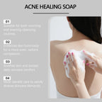 Virella Bacne Out Bar Acne Control Soap with natural ingredients for back acne treatment and clearer skin.